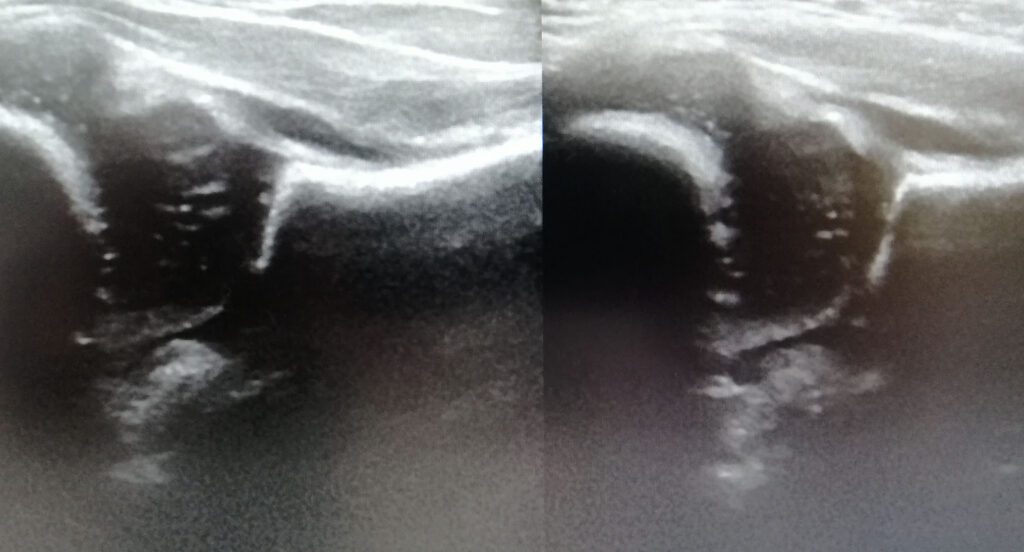 Infant hip ultrasound